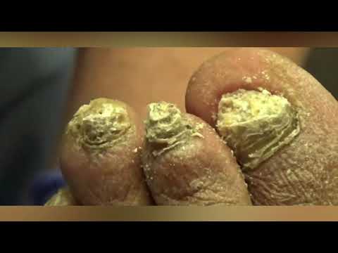 Long, Long, Nails - So Much Fungus 1 Long, Long, Nails - So Much Fungus 1