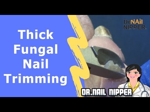 Are those Thick Fungal Toenail Trimming? Does that mean Fungus Toenails? 1