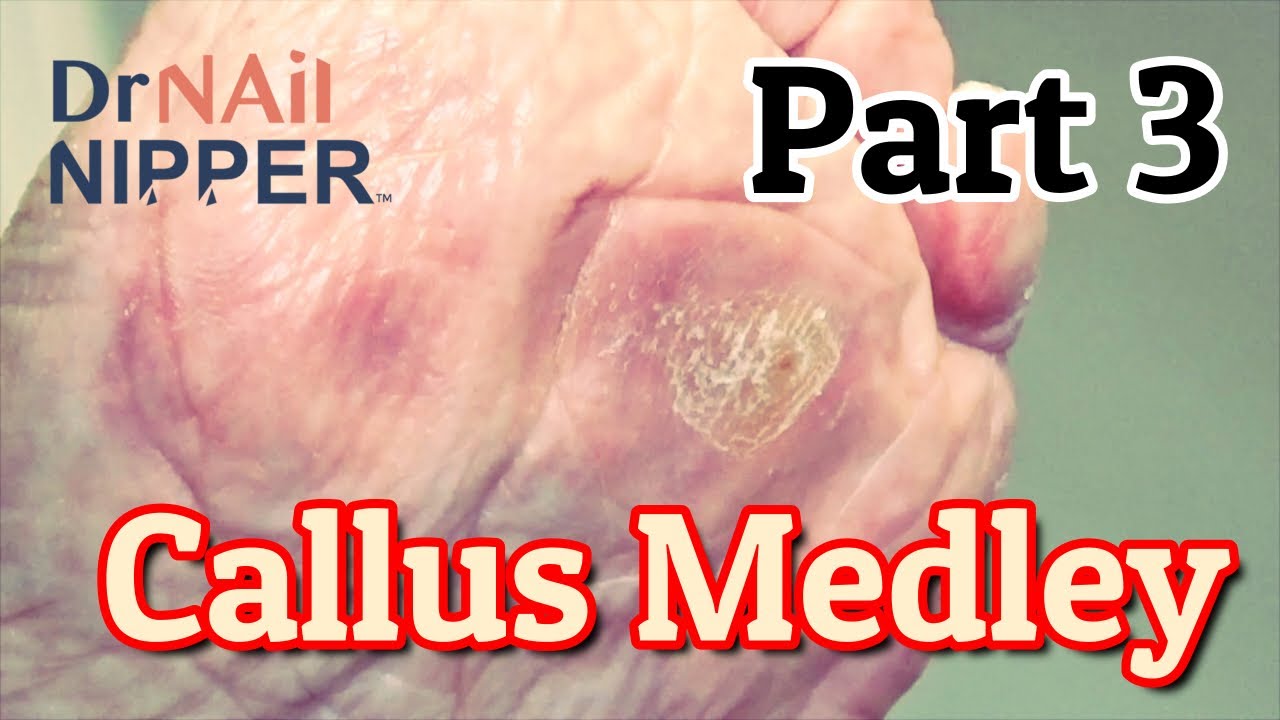 Callus Tuesday Medley Part 3 (2021) 6