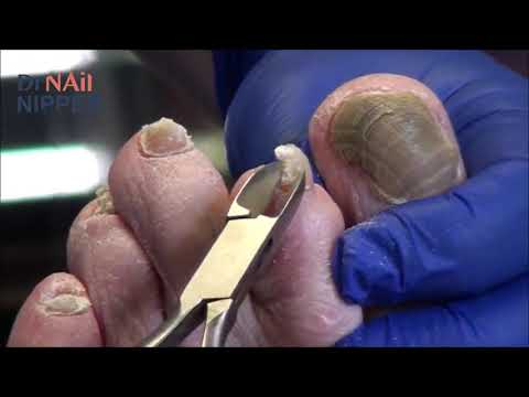 Sunday Bonus: Thickest Toenails and Bonus Rams Horn - Throwback from One Year Ago 1