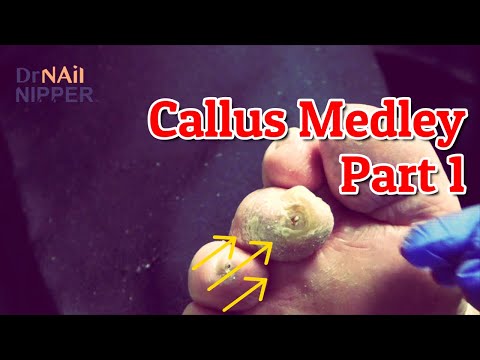 Callus Tuesday Members Part 1 (2021) - Are callus painful? Do they go with the MUSIC? 1