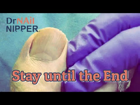 Callus Tuesday - Jazz, Callus and Foot Care (2021) 1