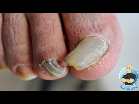 SUPER THICK TOENAILS = SUPER SATISFYING TRIMMING & FILING VIDEO 1