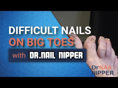 Difficult Toenails on Big Toes (2020) 1