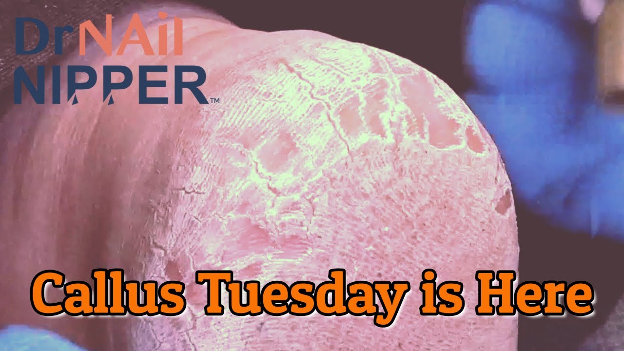How to treat a Callus? Callus Bliss with Richard [Callus Tuesday] (2021) 2