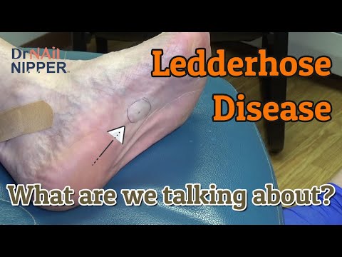 What is ledderhose disease? How is ledderhose disease treated? In the foot. (2021) Callus Tuesday 1