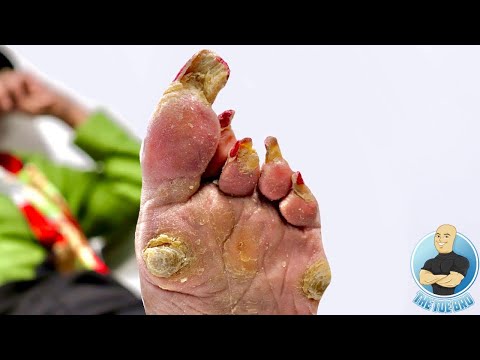 SHE'S BEEN HIDING HER FEET FOR YEARS FROM HER FAMILY ***PART 1: SUPER THICK & LONG TOENAILS*** 1