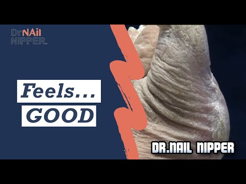 Trimming thick callus and toenails, Feels ... GOOD 1