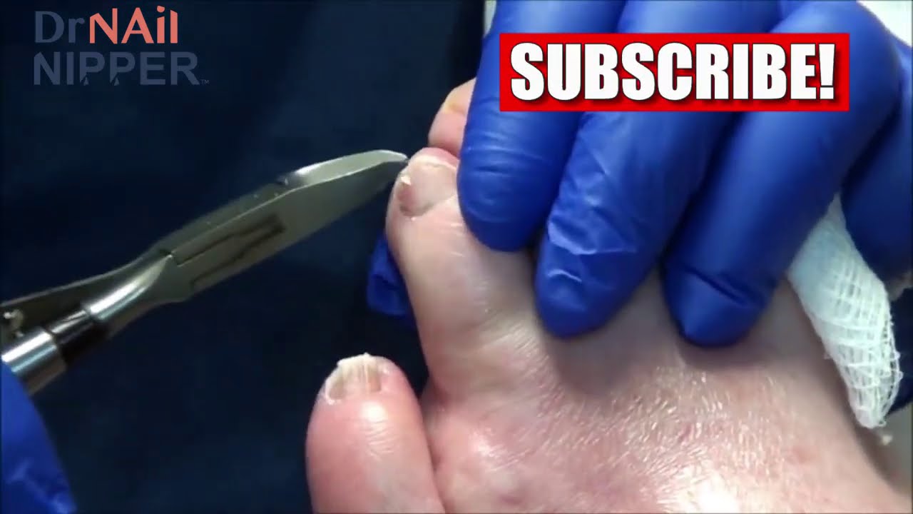 What are Diabetic Toenails? Daryl the Happy Patient with Diabetes 1 [Throwback Video] 1