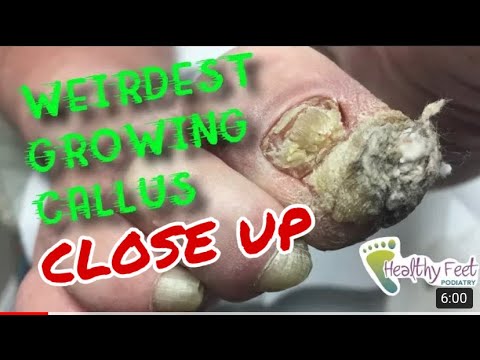 CLOSE UP LOOK at the Weirdest Growing Callus 1