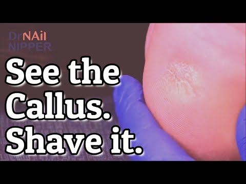 Why callus on feet? Marlene has Callus and Toenails [Callus Tuesday Throwback] 1