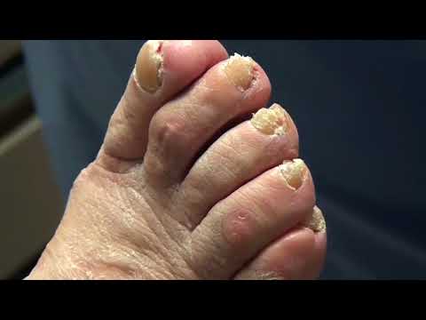 Grandma's Thick, Thick, THICK Nails! Dr. Nail Nipper 1