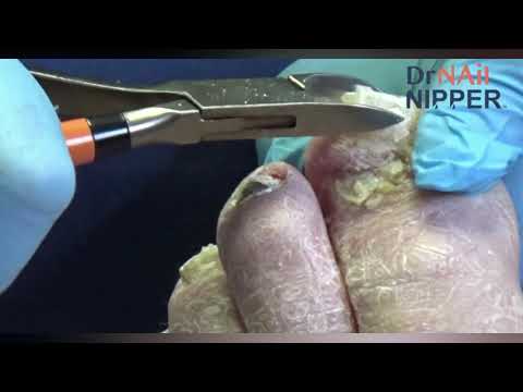 Scaly Skin, Fungal Nails 1