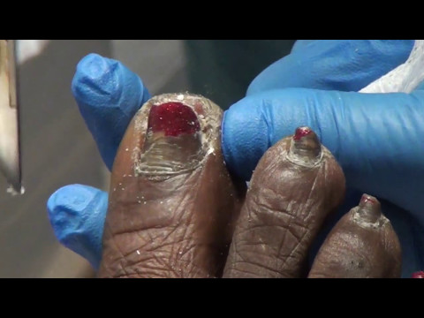 A nail trimming that was never published - thick fungal nails and calluses 1