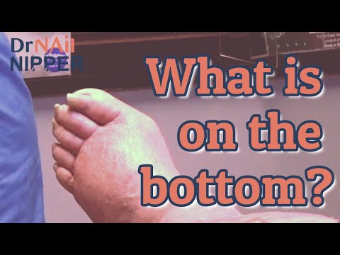 Can lymphedema go away? Toenails, Lymphedema, Athletes Foot. [Friday Feature Replay] (2021) 1