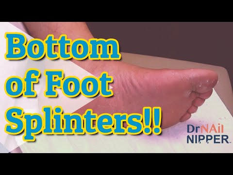How to get splinters out foot? Dr Nail Nipper and 30 Splinters on Bottom [Callus Tuesday] (2021) 1