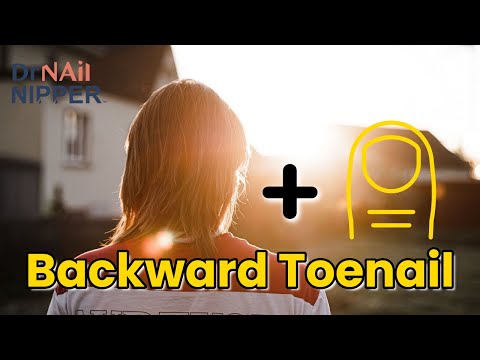 Backwards Toenail - Do you have this? [Throwback Thursday] 1