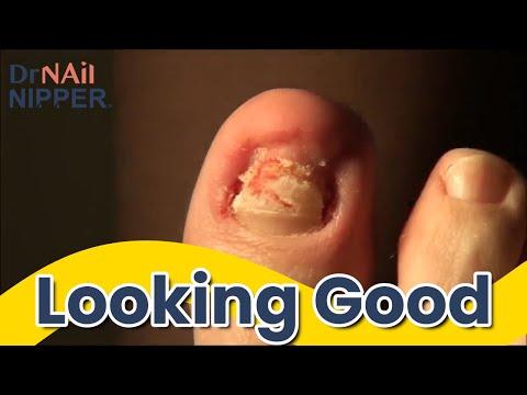 Do thick toenails hurt? Nervous Patient with Dr Nail Nipper {Throwback] 1