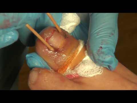 Dr. Nail Nipper's Ingrown Summer 1
