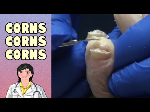 Corns, Hammertoes, and More Corns 1