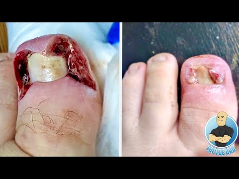 EXTREME OVERGROWN TOENAIL SURGERY GONE WRONG??? 1