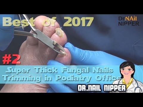 #2 Best of 2017 - Super Thick Fungal Nails Trimming in Podiatry Office - Dr Nail Nipper 1