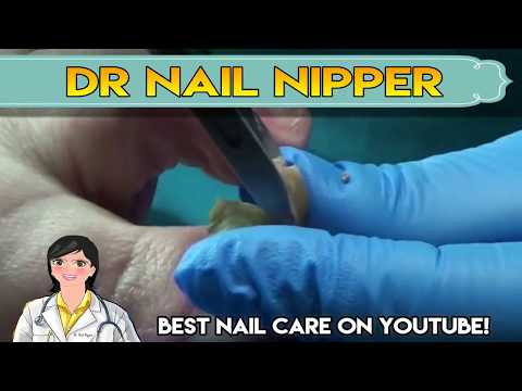 Thickest toenails and Calluses on YouTube! Dr. Nail Nipper 1