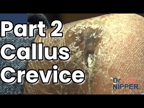 Part 2 - Callus in 60 Minutes. How to treat callus? [Callus Tuesday] (2021) 1