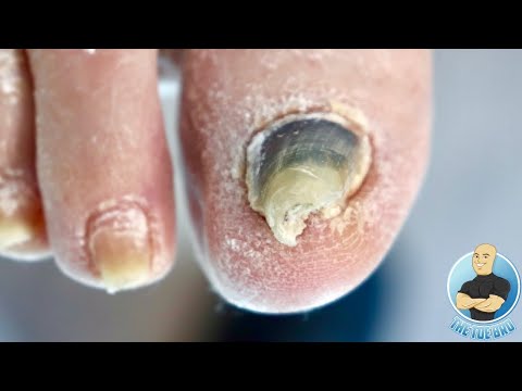 WHY IS HER BIG TOENAIL SO THICK & DARK?! ***HOW TO TREAT DAMAGED TOENAILS*** 1
