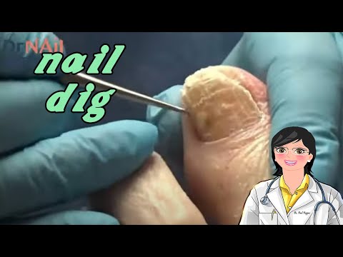 Painful fungal nails 1