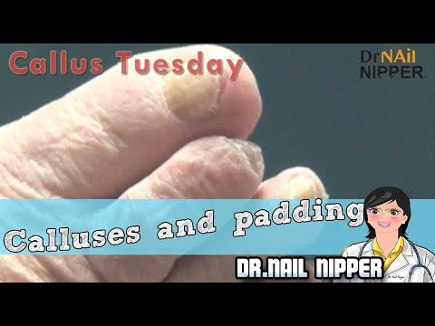 Have you seen Calluses on Foot Padding? #16 - Callus Tuesday 1 Have you seen Calluses on Foot Padding? #16 - Callus Tuesday 1