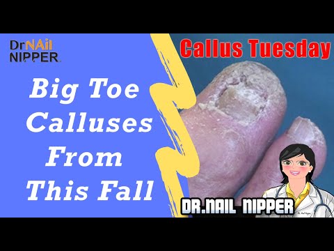 Big Toe Calluses from This Fall [Callus Tuesday] (2019) 1