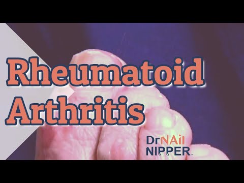 What is rheumatoid arthritis? Patient and Dr Nail Nipper.. FEET-ure Friday (2021) 1