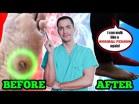 Cutting Out A Ginormous Corn (Seeded Callus) After Stepping On Glass! 1