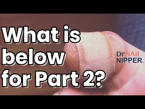 Big Toe Callus - The WHOLE Video (Part 1 and 2) - Throwback 1