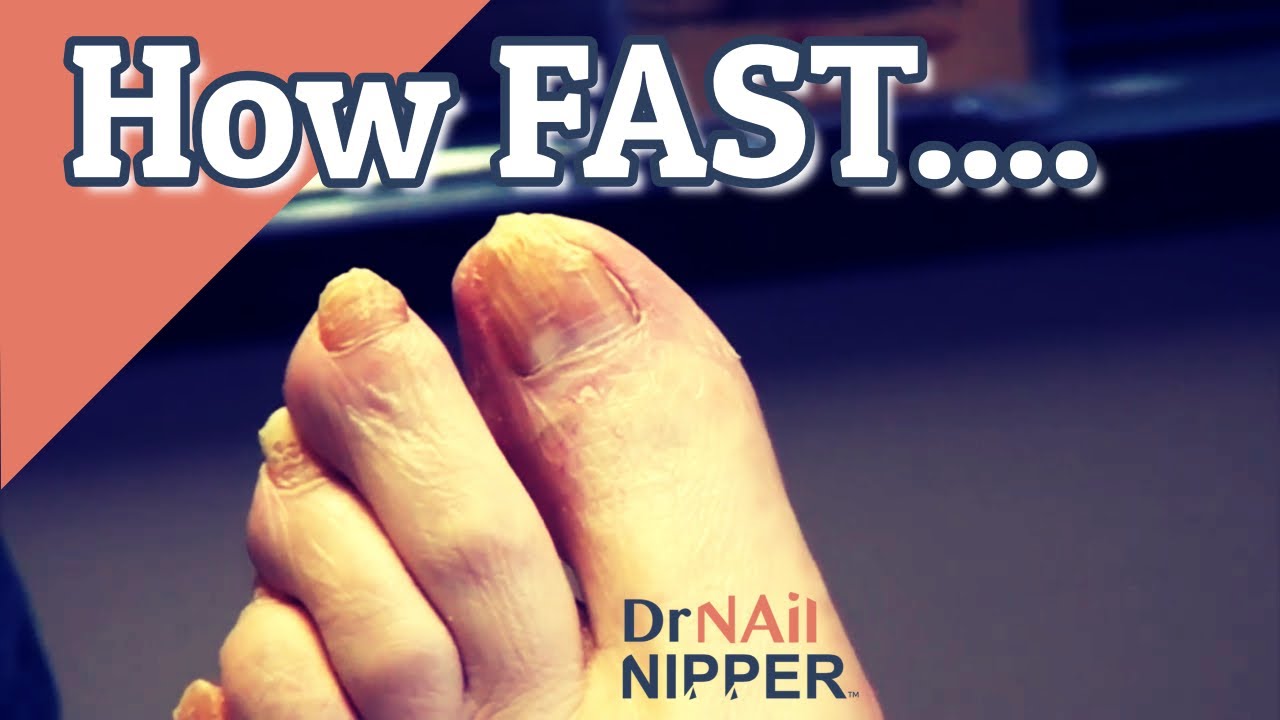 How To Make Your Toenails Grow Back Faster at Doyle Slocumb blog