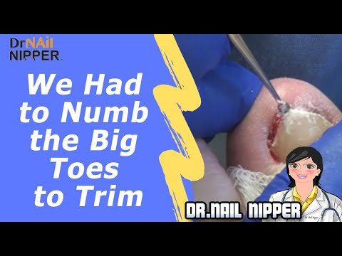 We Had to Numb the Big Toes to Trim 1 We Had to Numb the Big Toes to Trim 1