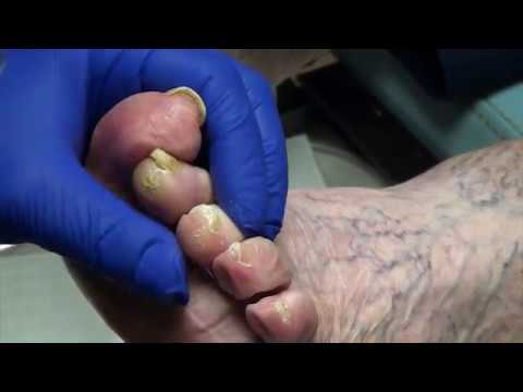 More Toenail and Corn Trimming - Plus Eclipse photos!! 1 More Toenail and Corn Trimming - Plus Eclipse photos!! 1