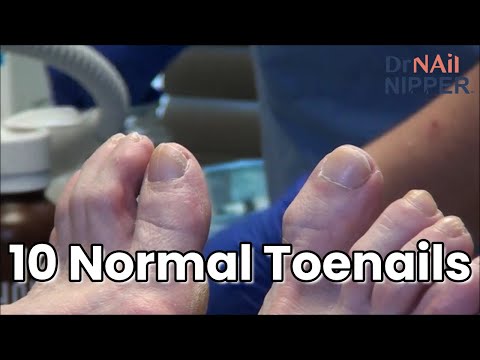 Throwback Thursday - Normal Toenails 1