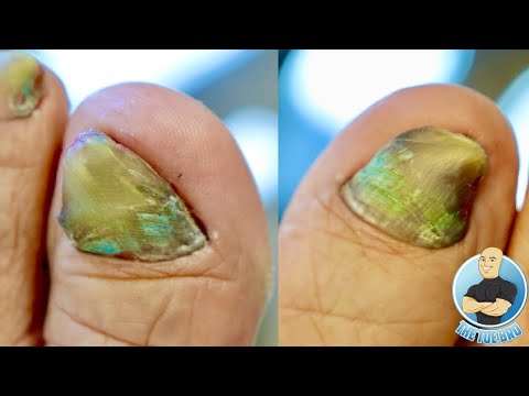 HER TOENAILS ARE TOO THICK AND HARD TO CUT!!! ***HOW TO TREAT DAMAGED TOENAILS*** 1 HER TOENAILS ARE TOO THICK AND HARD TO CUT!!! ***HOW TO TREAT DAMAGED TOENAILS*** 1