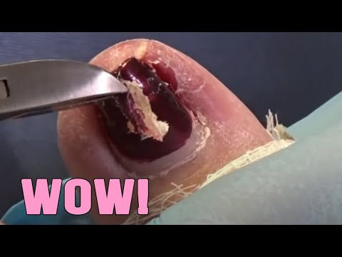 Ingrown Nail Relieved 1 Ingrown Nail Relieved 1