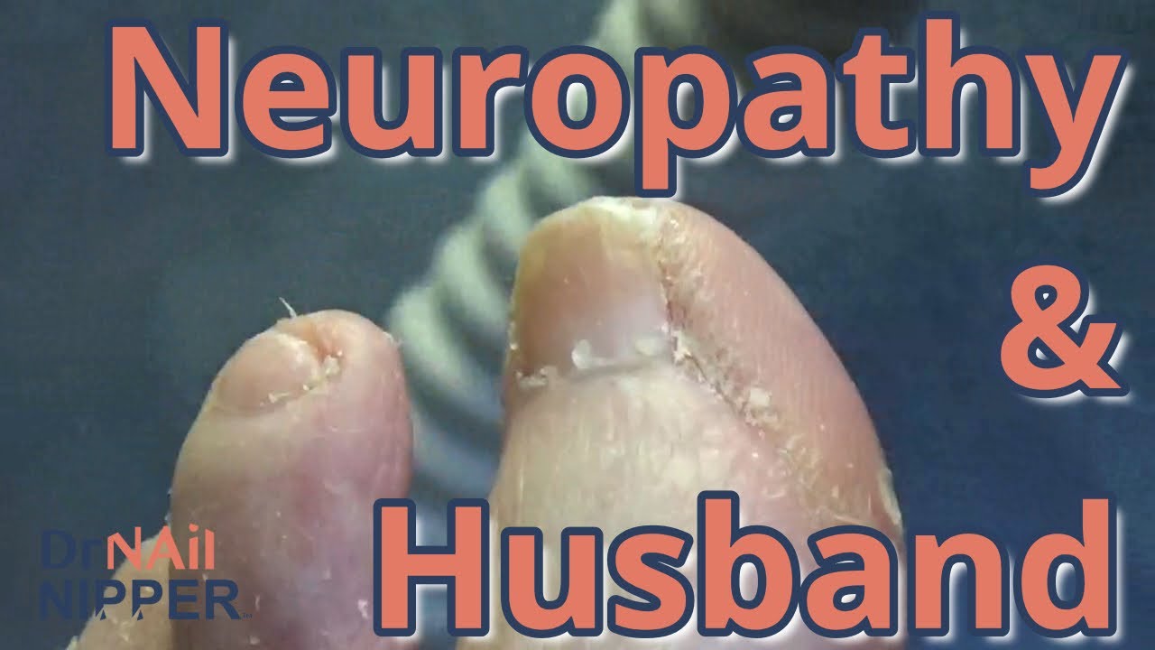 How to treat neuropathy? Dr Nail Nipper and patient talk about her husband. FEET-ure Friday (2021) 1
