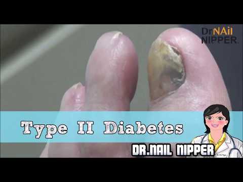 Type 2 Diabetes Foot Care Patient 1 Type 2 Diabetes Foot Care Patient 1