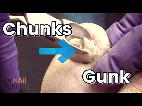 Chunks and Gunk with Music - Dr Nail Nipper (2021) 1