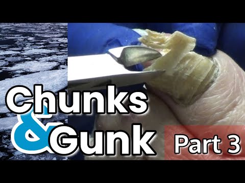 Chunks and Gunk #3 - Dr Nail Nipper 1