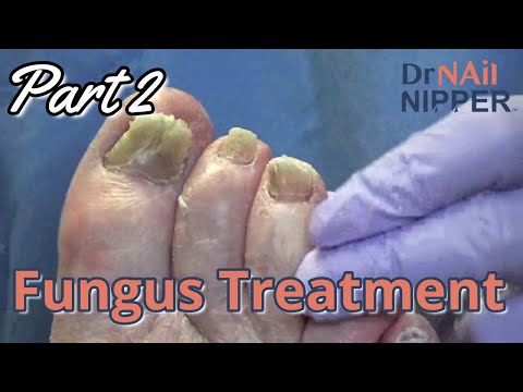Fungus Treatment Discussion, Part 2 - Fungal Toenail Extended (2021) 1