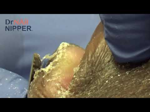 Extreme Thick Fungal Nails - And Music - Pt 1 1