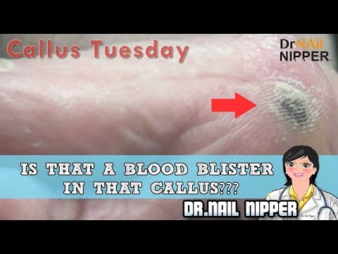 Is that a Blood Blister in that Callus? #27 - Callus Tuesday 1