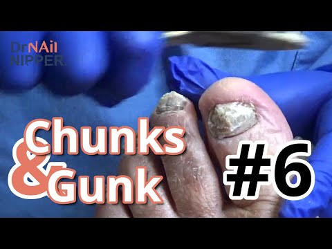 Chunks and Gunk #6 with Relaxing Music - Dr Nail Nipper (2021) 1