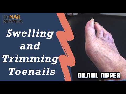 Swelling and Trimming Toenails 1